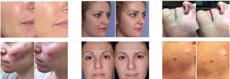 Luz Facial LED Infravermelha Terapia LED PDT Máquina Profissional Bio Fotomodulação Luz de Fototerapia LED 4