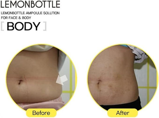 Solução de frasco de limão Lipólise para rosto e corpo 10 ml X 5 frascos de limão
